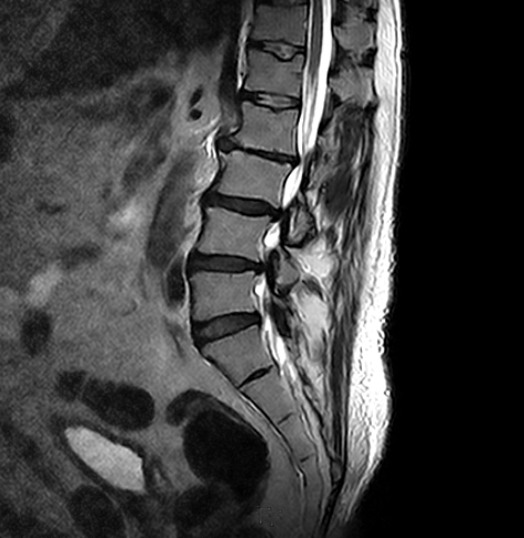 Lumbar Sagittal Neutral Spine MRI Scan